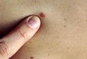 Methods of Mole Removal