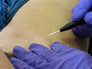 Radio Mole Removal