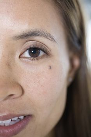 Black Mole Removal Black Mole Removal