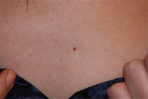 Cherry Mole Removal Cherry Mole Removal