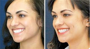 Cosmetic Mole Removal Cosmetic Mole Removal