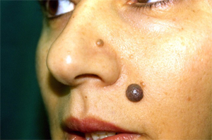 Facial Mole Removal Cost Facial Mole Removal Cost
