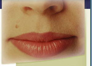 Facial Mole Removal Scarring Facial Mole Removal Scarring