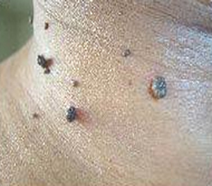 Large Mole Removal Large Mole Removal