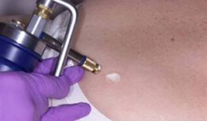 Liquid Nitrogen for Mole Removal Liquid Nitrogen for Mole Removal