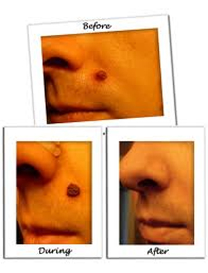 Mole Removal Cream: Does It Work Mole Removal Cream: Does It Work