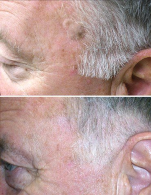 Mole Removal in Birmingham Mole Removal in Birmingham