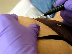 Mole Removal in England Mole Removal in England