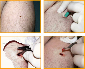 Mole Removal in Glasgow Mole Removal in Glasgow