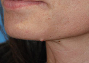 Mole Removal in Newcastle Mole Removal in Newcastle