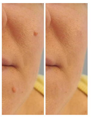 Mole Removal in the UK