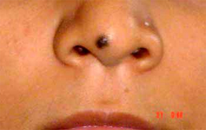 Mole Removal on Nose