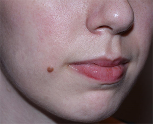 Raised Mole Removal Raised Mole Removal