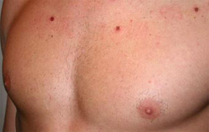 Small Mole Removal Small Mole Removal