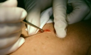 Surgical Mole Removal Cost Surgical Mole Removal Cost