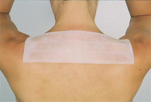 Surgical Mole Removal Scarring Surgical Mole Removal Scarring