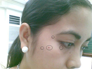 Wart and Mole Removal Wart and Mole Removal